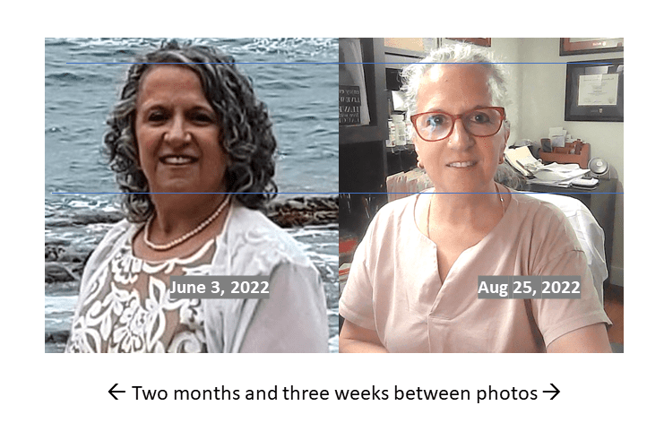 Facial resolution after treatment