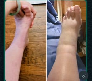 Leg edema comparison