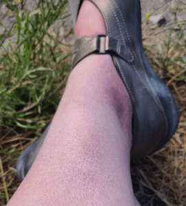 75% resolution of purpura