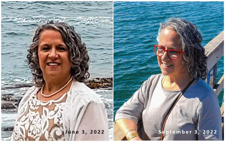 Comparison of hair loss before and after hypothyroidism diagnosis