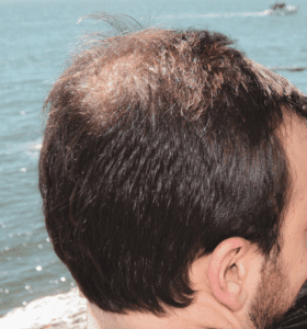 Male pattern baldness