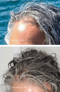 Hair regrowth progress photo