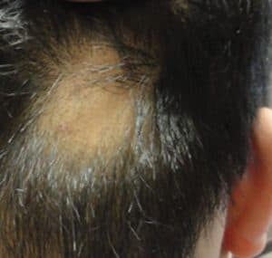Alopecia areata patches