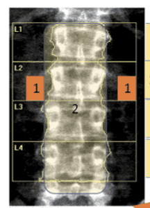 Spinal DEXA image quality