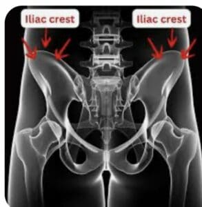 Diagram showing the top of the hip bone (the iliac crest)